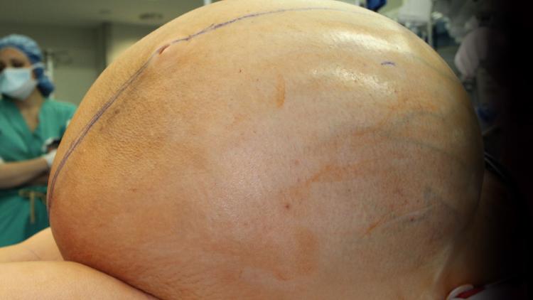 Connecticut Woman’s Rare 132-Pound Tumour Removed In Lifesaving Surgery