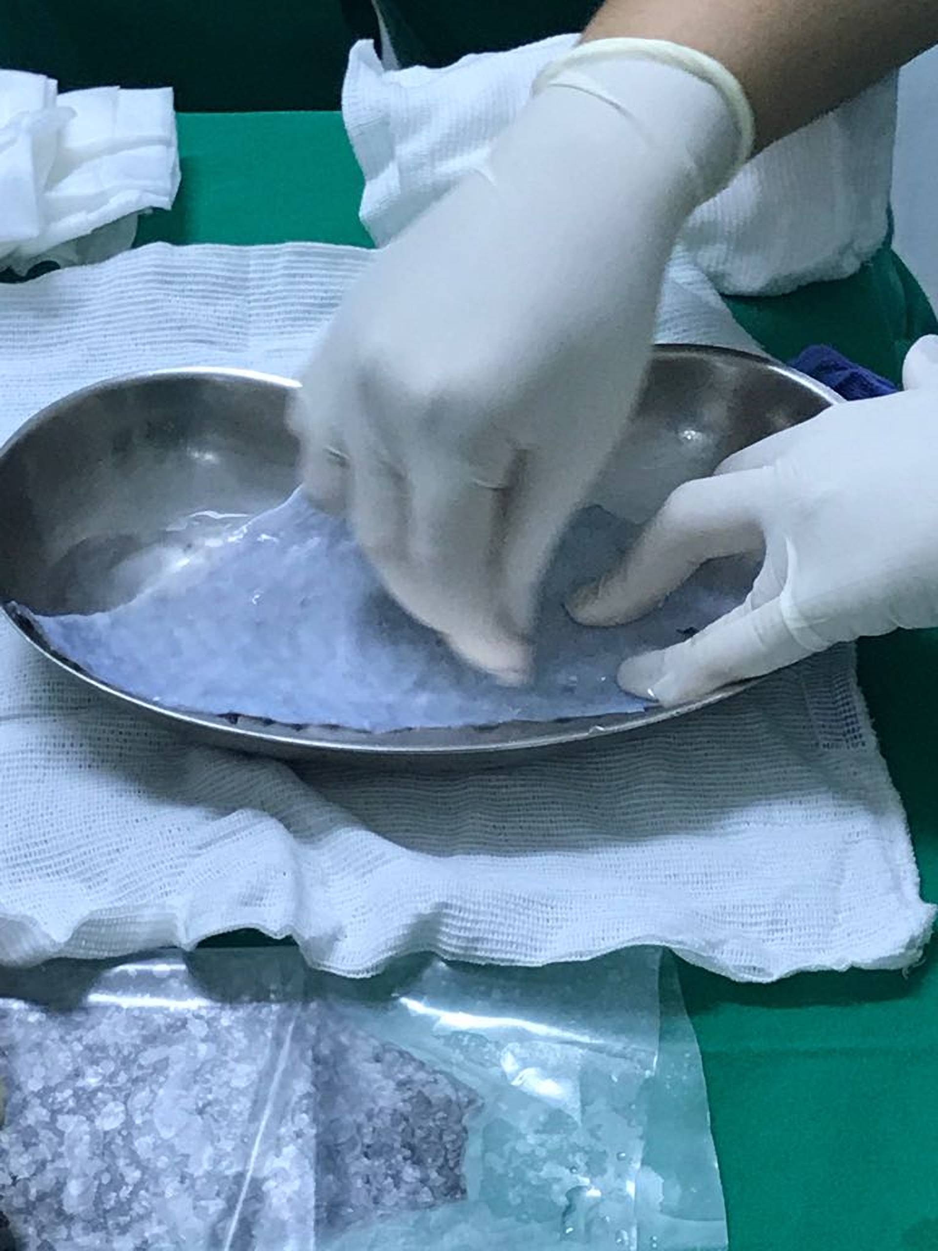 Woman Born Without A Vagina Has Been Given One Using Tilapia Fish Skin ( Neovaginoplasty)