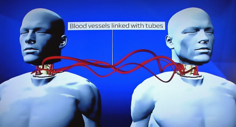 World’s First Head Transplant Volunteer Could Experience Something “Worse Than Death”