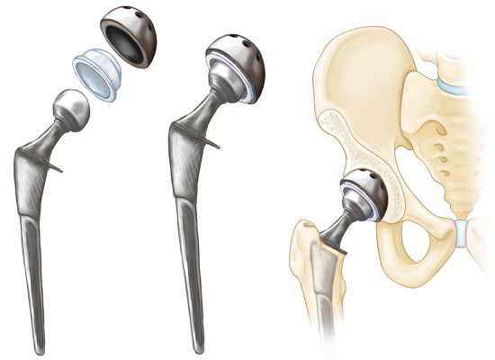 Cemented vs. Cementless Alternatives in Joint Replacement