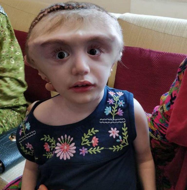 Girl, 2, undergoes pioneering surgery in bid to shrink head