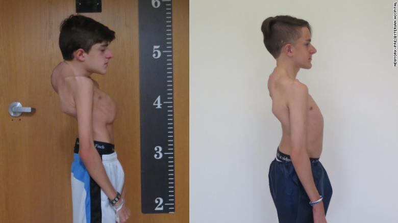 Dying from scoliosis, ‘bending by the hour’ – 18th Surgery that changed his life