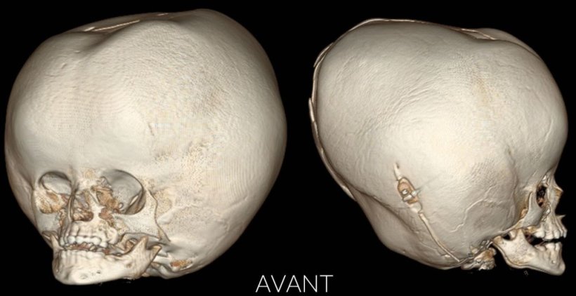 Surgeons reconstruct girl’s skull after her head swells to dangerous size