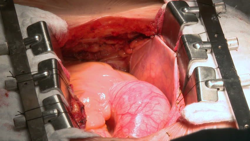  Open Heart Bypass Surgery