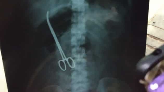 Three months after surgery, doctors find forceps inside woman’s abdomen in Hyderabad