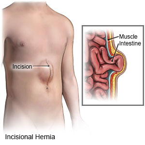Incisional Hernia: What It Is and How It’s Treated