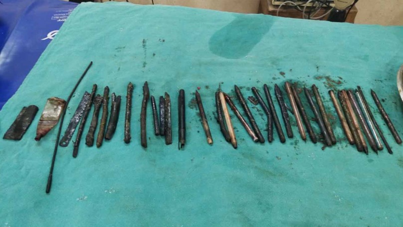 Surgeons Remove 33 Objects From Man’s Stomach, Including Razor Blades Claire Reid in NEWS