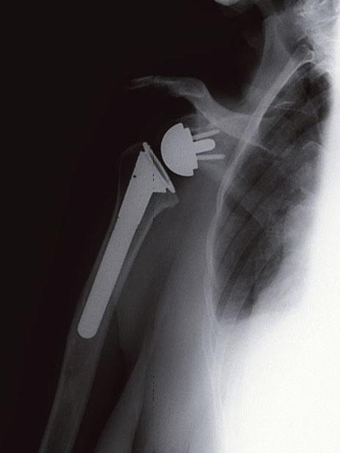 Shoulder Replacement: Recovery, What to Expect, Risks, and More