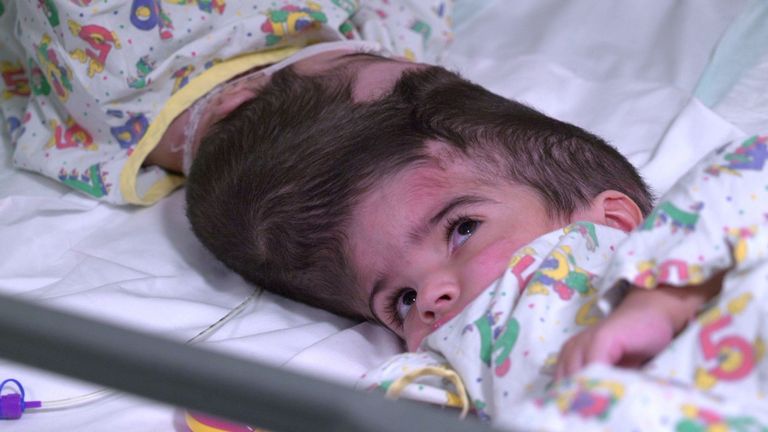 Twins conjoined by skulls separated after 50 hours of operations