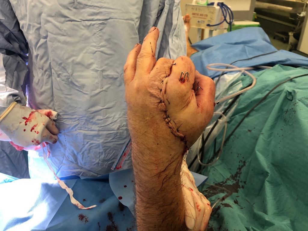 Man’s hand left dangling by skin and bone reattached by surgeons after sewing it to his groin for two weeks
