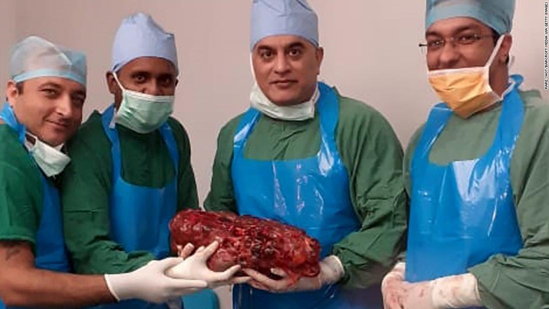 Doctors remove giant kidney weighing 16.3 pounds