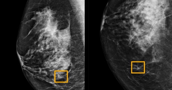 Google’s New Artificial Intelligence Outperforms Experts in Diagnosing Breast Cancer