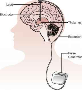 pain Atypical brain facial stimulation deep