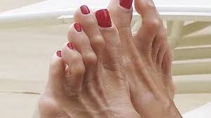 Hammertoe: The deformity of the 2nd, 3rd and 4th toes