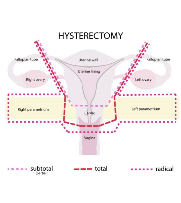 What you can expect after Hysterectomy – The Journey to Recovery