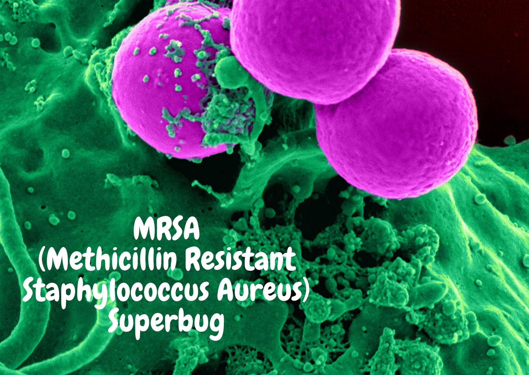 MRSA (Methicillin-resistant Staphylococcus aureus): What you need to know!