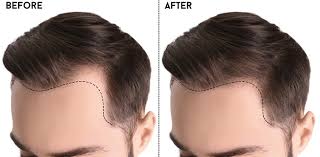 Scope of laser surgery as a hair transplant procedure