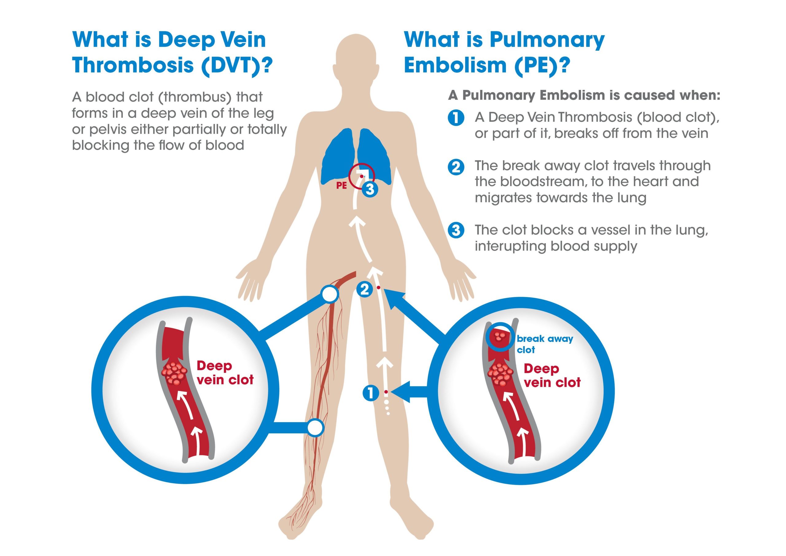Venous Thromboembolism (DVT/PE)- Facts