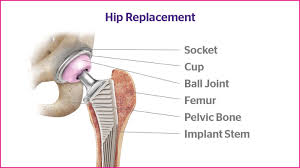 Hip Replacement Surgery Has Come A Very Long Way