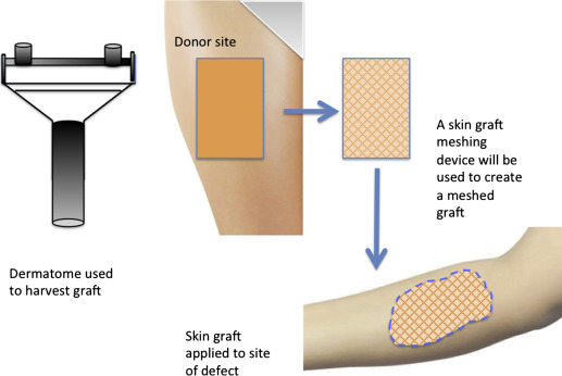 Different Types of Skin Grafts Used for Wound Closure
