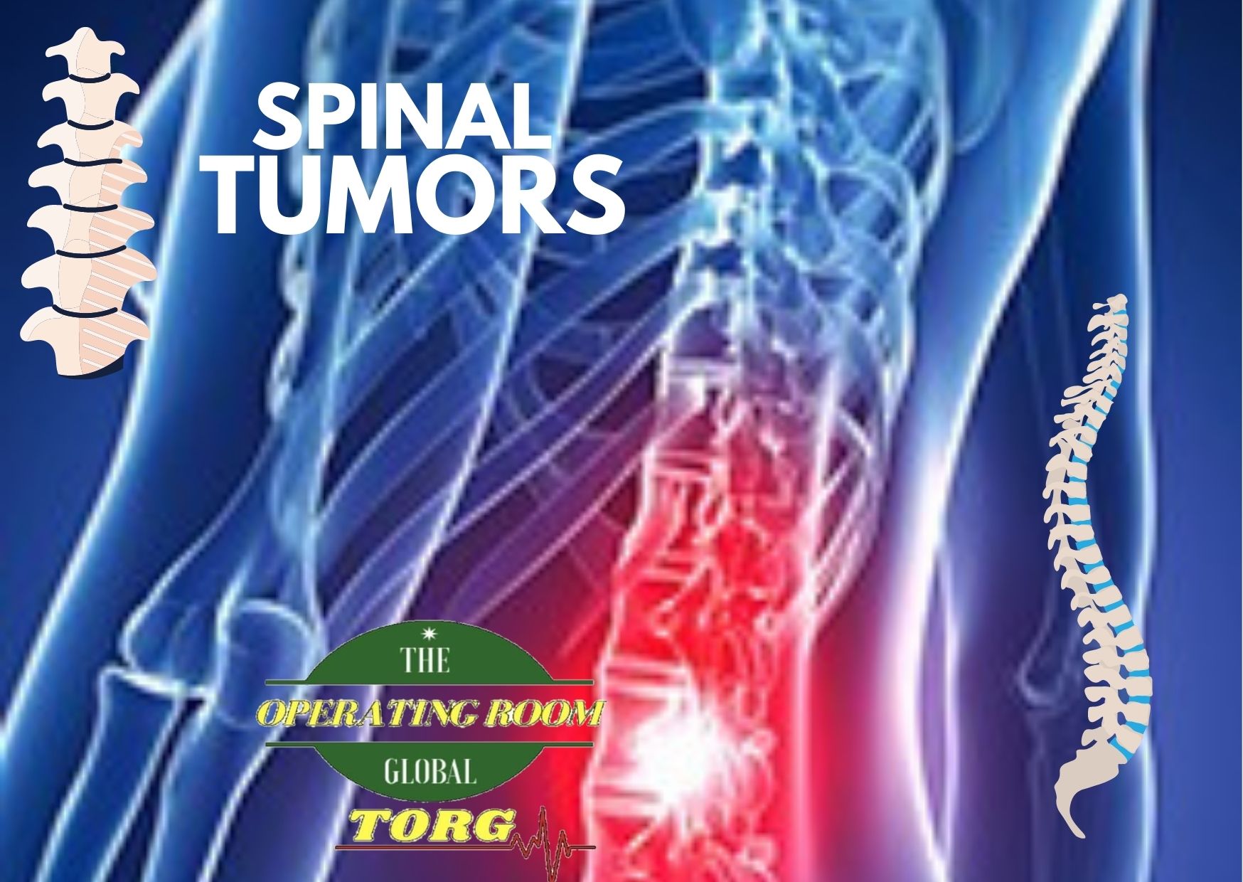 Spinal Tumors – What you need to know!
