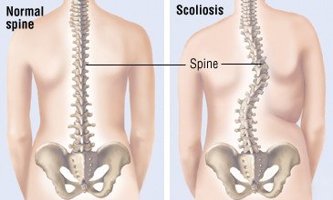Scoliosis – What you need to know!