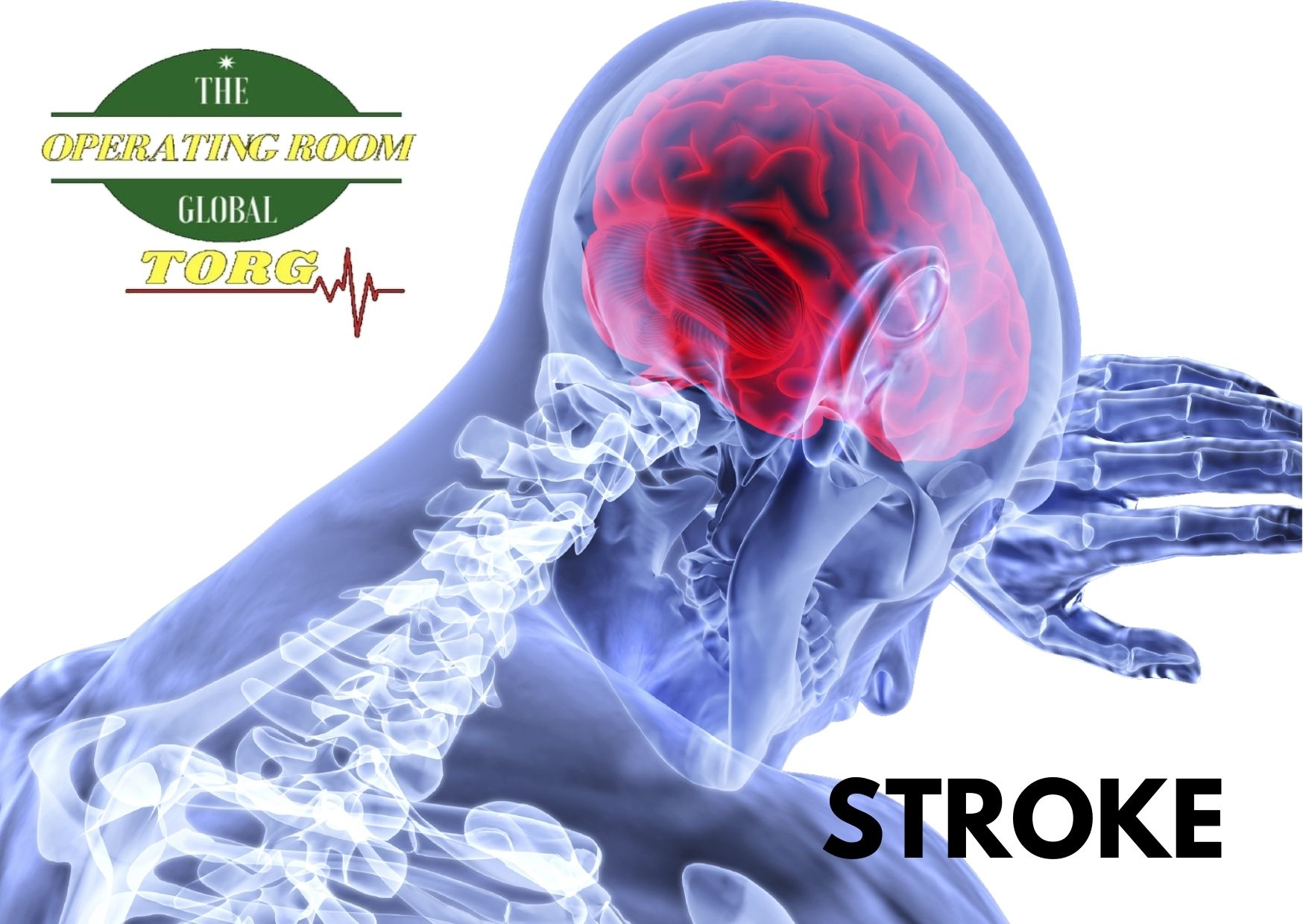 Stroke – Cardiovascular Accident: What you need to know!