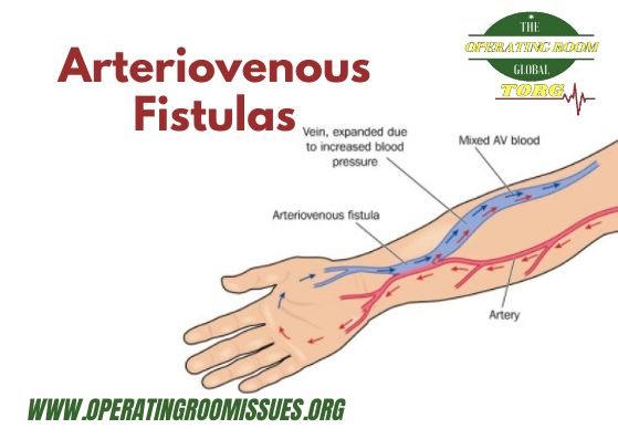 Arteriovenous Fistulas – What you need to know!