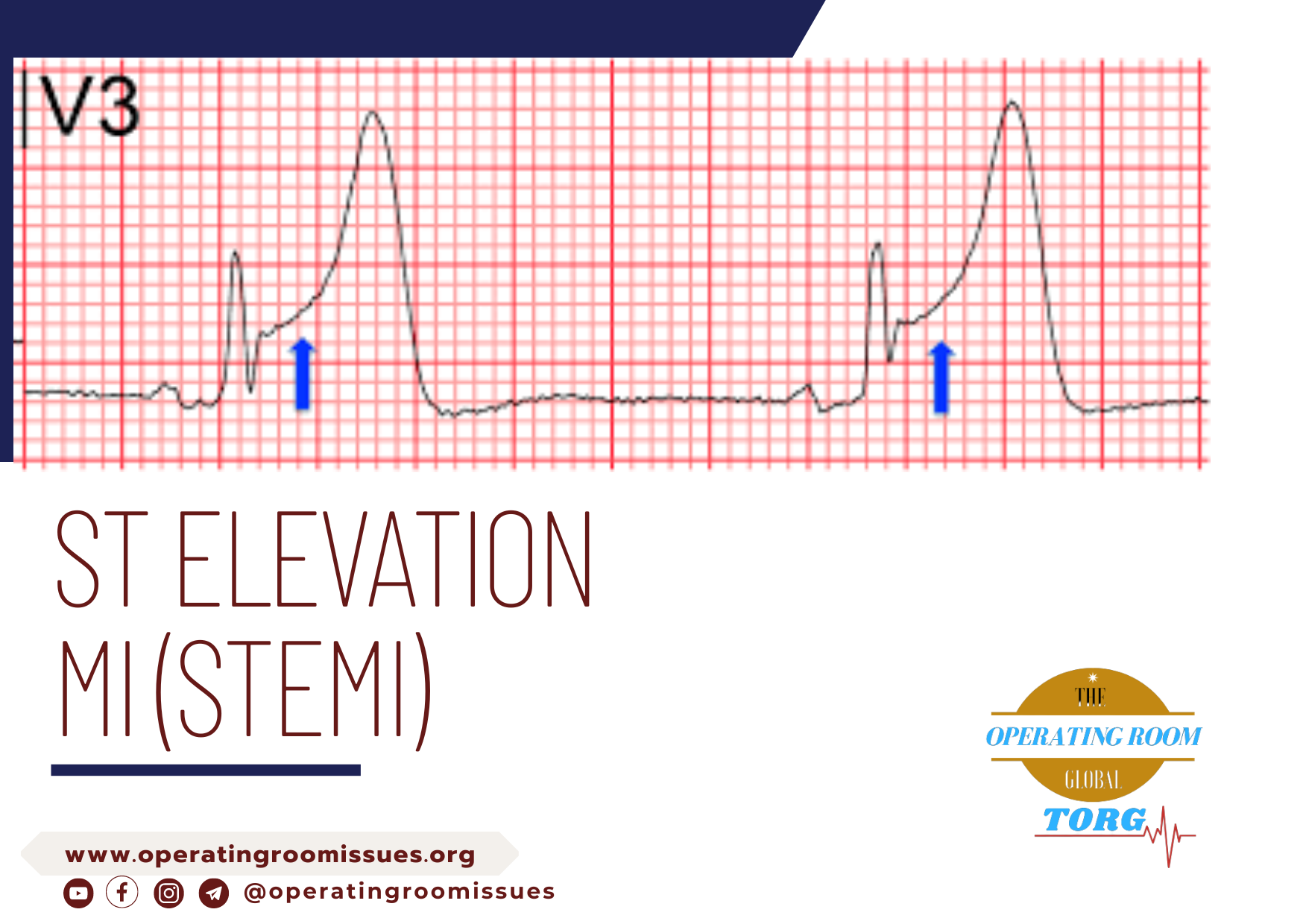 ST Elevation MI (STEMI) – What you need to know!